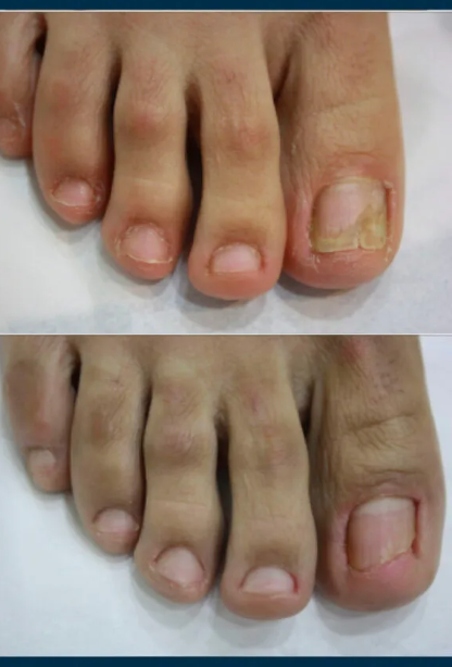 Example of changes in nail appearance